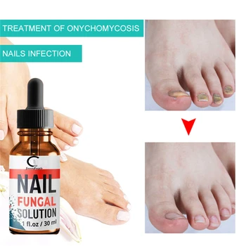 GPGP Greenpeople Nail Repair Essence Nail Glive Odstranitev Anti Onychomycosis Noge, Nego, Zdravljenje Glivičnih Nohtov Popravila Tekoče